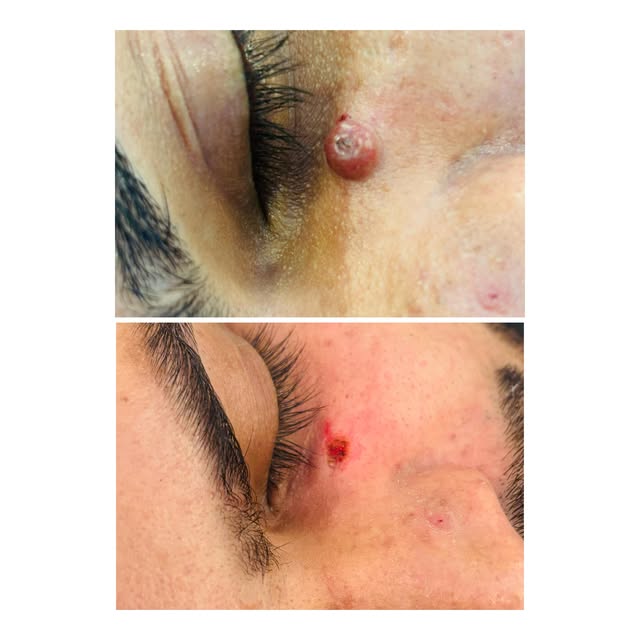 Mole removal
