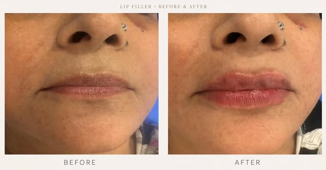 Lip filler