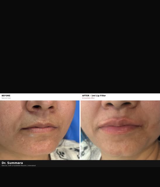 Natural lip enhancement