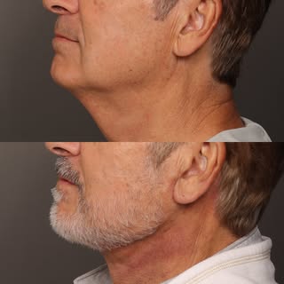 This patient is only three weeks out from Lower face contouring. The jawline and neck are already lo