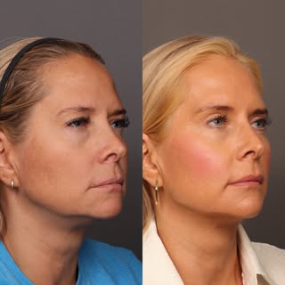 Two and a half months after an upper blepharoplasty and a lower lid skin pinch. Tightening the upper