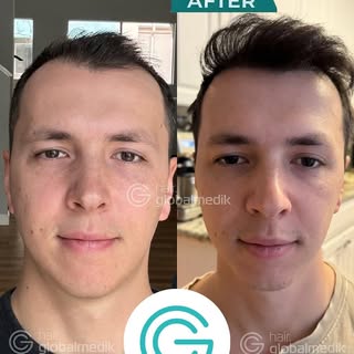 HAIR TRANSPLANT 🔻

🔝 9 months after the hair transplant (final result at 12 months)
👉🏻 Visit our