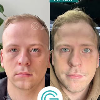 HAIR TRANSPLANT 🔻

🔝 9 months after the hair transplant (final result at 12 months)
👉🏻 Visit our