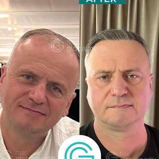 HAIR TRANSPLANT 🔻

🔝 8 months after the hair transplant (final result at 12 months)
👉🏻 Visit our