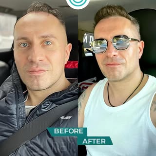 🔥 1.5 years after the hair transplant - natural, confident, long-lasting results.

A successful hai