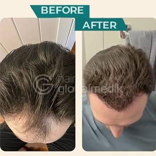 Wow result 🔥
6 months after the hair transplant
 (final result at 12 months)

Visit our website: ha