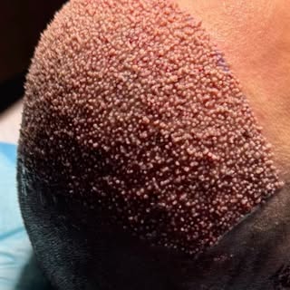 HAIR TRANSPLANT
7 months after surgery

4200 grafts 
Method DHI

Visit our website hairglobalmedik.c