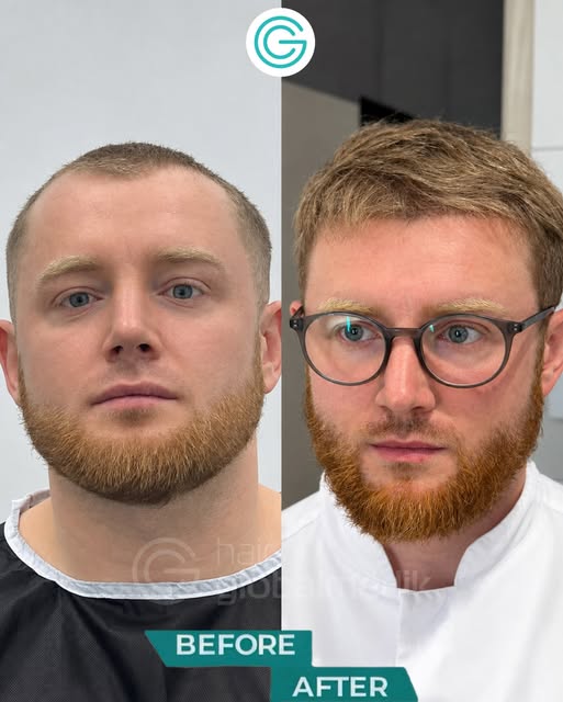 DHI Hair Transplant - 6-Month Result 🔥

A total of 3,600 grafts were transplanted using the DHI (Di