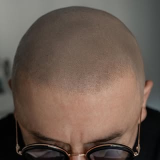🚨 fresh shaved look 🚨 vorher u. nachher🔥🔥 

Eine echte Verwandlung durch unsere Kopfhautpigmenti