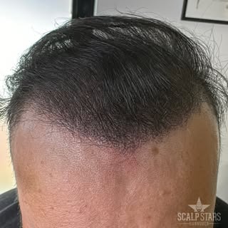 Haarverdichtung🔥 was für ein Unterschied! Hast du Probleme mit Haarausfall oder lichtem Haar ? Lass