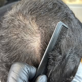 Hier könnt ihr ein Beispiel für eine Haarverdichtung erkennen. Links nach der ersten Behandlung- rec