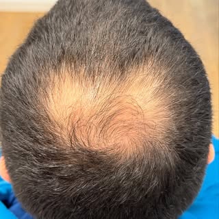 Haarverdichtung im Turnus💯

Warum eine Haarverdichtung?
✅Sofortiges Ergebnis 
✅Sofort Alltagstaugli
