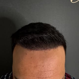Haarverdichtung mit der Kopfhautpigmentierung ‼️

In nur 3 Sitzungen wird eine perfekte Haarverdicht