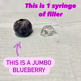 Ever wonder what 5 syringes of filler looks like?Check this out, now you can picture it the next tim