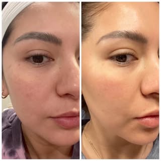 Check out my BBL/HALO journey! Now let’s get to business! 

BBL (broadband light) photofacial: 
Grea