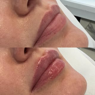 Naturalne usta 👄? 
To to co lubimy najbardziej !
A tutaj usta naszej pacjentki wykonane przez @dr_w