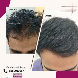 Before & After PRP/GFC Hair Restoration at Skin Ayurveda Clinic

From thinning to thriving — GFC wit
