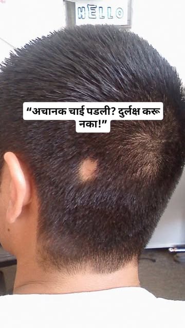 Alopecia Areata is an autoimmune condition in which the immune system mistakenly attacks hair follic