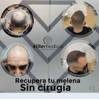 La infiltración trimestral de minoxidil y dutasteride acompañada de un adecuado tto oral consigue re