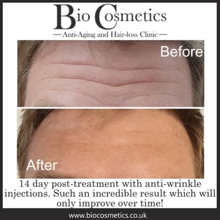 Anti-wrinkle injections giving impressive results. A 'tweakment' to achieve a refreshed, natural loo