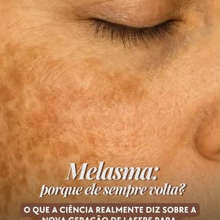 Ela chegou!!!

A ponteira que eu estava esperando para tratar melasma e manchas com mais precisão já