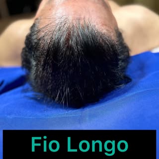 Evolução de mais um #transplantecapilar #fiolongo
Antes e logo após a finalização do procedimento ci