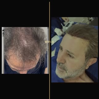 Resultado super natural imediatamente após o término da cirurgia de transplante capilar com fios lon