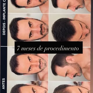 Contribuição do nosso querido paciente @adilson.hono que está com 7 meses de procedimento de transpl