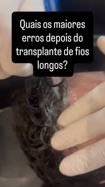 🚨 Um erro no banho pode comprometer seu pós-transplante.
Depois do transplante capilar de fios long