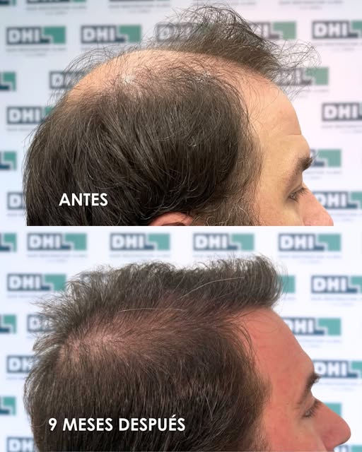 Este antes y después no es solo un cambio de cabello. 

Es todo lo que viene después:
más confianza,