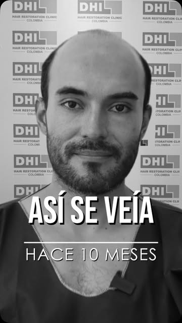 Así se veía nuestro paciente antes de su implante capilar… y mira cómo se ve hoy.

Más seguro, más f