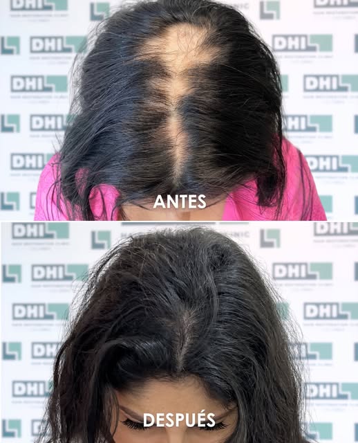 Menos filtros, más confianza. Más resultados, menos dudas.

Comenta “implante” y da el primer paso p