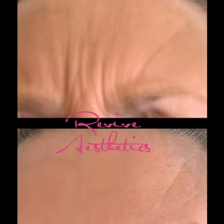 BEFORE & AFTER ✨
With Anti-wrinkle injections to soften lines and prevent wrinkles 😊
#revivehaircli