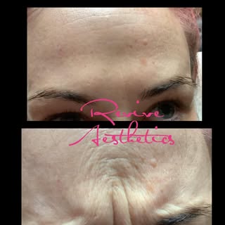 BEFORE & AFTER ✨
With Anti-wrinkle injections to soften lines and prevent wrinkles 😊
#revivehaircli