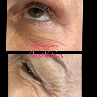 BEORE & AFTER✨
With Anti-wrinkle injections to soften lines and prevent wrinkles 😊
#revivehairclini