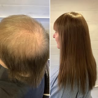 Amazing transformation by Revive Hair systems#hairreplacement #nonsurgicalhairreplacement #hairloss#