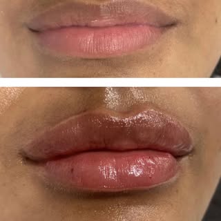 1 ml #revivehairclinicltd #lipaugmentation #lipfillerstamworth #lipfillerslichfield #lipfillerbefore