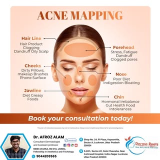 Acne mapping helps identify possible internal and lifestyle triggers behind breakouts on different a