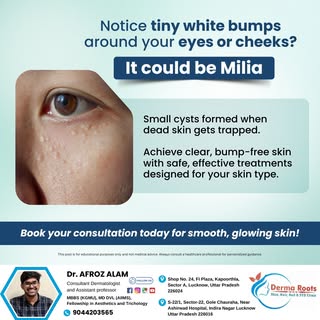 Milia are small, white bumps that form when dead skin cells get trapped beneath the surface. Though 