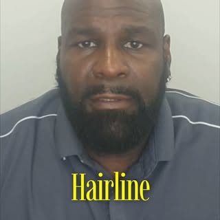 What truly changes after SMP. The honest version.
-
[hair loss, balding, SMP, Scalp Micropigmentatio