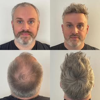 Meet Gavin, aged 41. He has been suffering from male pattern baldness for years, Gavin embraced his 