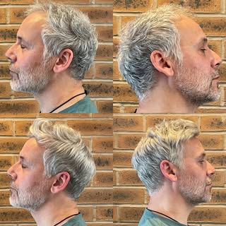 Meet Simon, aged 55. He has been suffering from male pattern baldness for a couple of years, Simon e