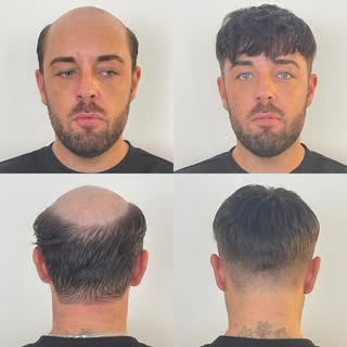 Meet Daniel, and existing hair system wearer the choose NEU Hair 4 Men as a model for one our 121 tr