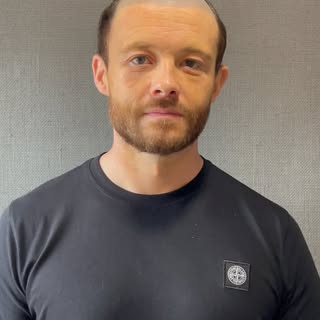 Meet Lloyd, aged 39. He has been suffering from male pattern baldness for some years. Lloyd had trie