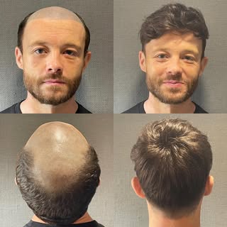 Meet Lloyd, aged 39. He has been suffering from male pattern baldness for some years. Lloyd had trie