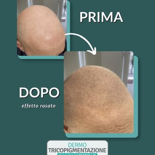 Pima e dopo tricopigmentazione effetto rasato su testa glabra

L'effetto ideale se sei completamente