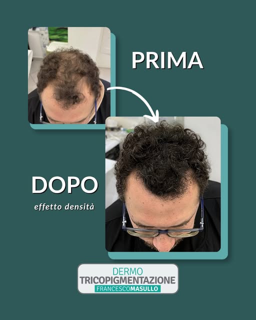 Prima e dopo del trattamento di tricopigmentazione con effetto densità

Una tecnica per dare l'illus