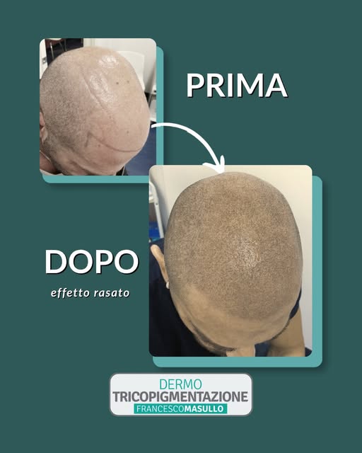 Prima e dopo tricopigmentazione effetto rasato

Siamo partiti da una testa quasi glabra e abbiamo ri