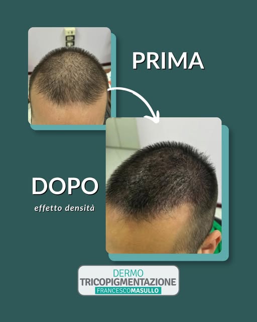 L'effetto densità è un tipo di tricopigmentazione per camuffare il diradamento in alcune zone della 