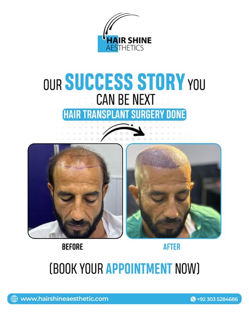 𝐘𝐨𝐮𝐫 𝐍𝐞𝐰 𝐇𝐚𝐢𝐫 𝐒𝐭𝐨𝐫𝐲 𝐒𝐭𝐚𝐫𝐭𝐬 𝐇𝐞𝐫𝐞!
#HairTransplant #HairShineAesthetics #Hai